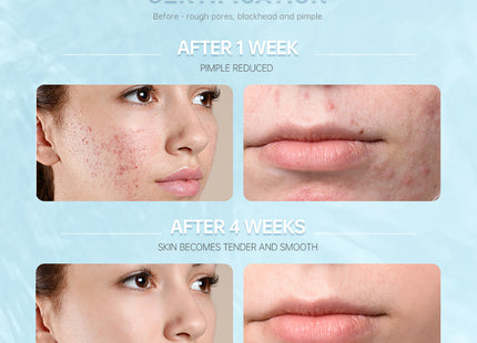 Salicylic Acid Repair Lotion Moisturizing And Repairing Sensitive Skin